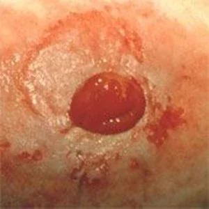 Irriterad peristomal hud